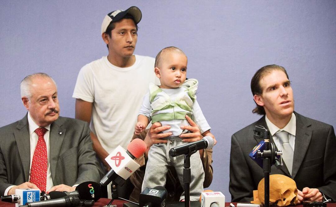 El menor nació con un diámetro craneal anteroposterior incrementado, lo que implicaría una falta de expansión de su cerebro.