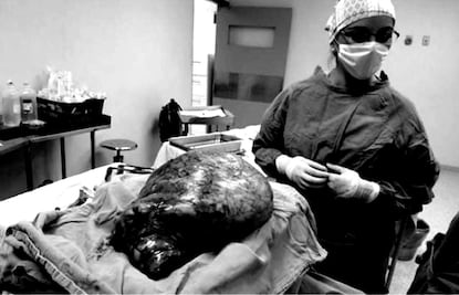 Extirpan tumor de 17 kilos a una mujer en Durango