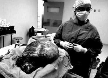 Extirpan tumor de 17 kilos a una mujer en Durango