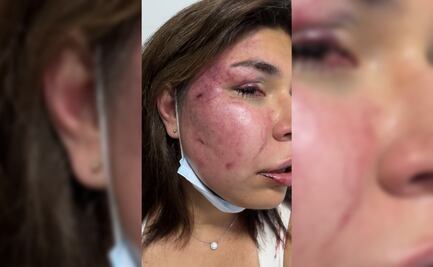 Ofrece canciller Bárcena apoyo a fotógrafa mexicana agredida en Colombia por un estadounidense