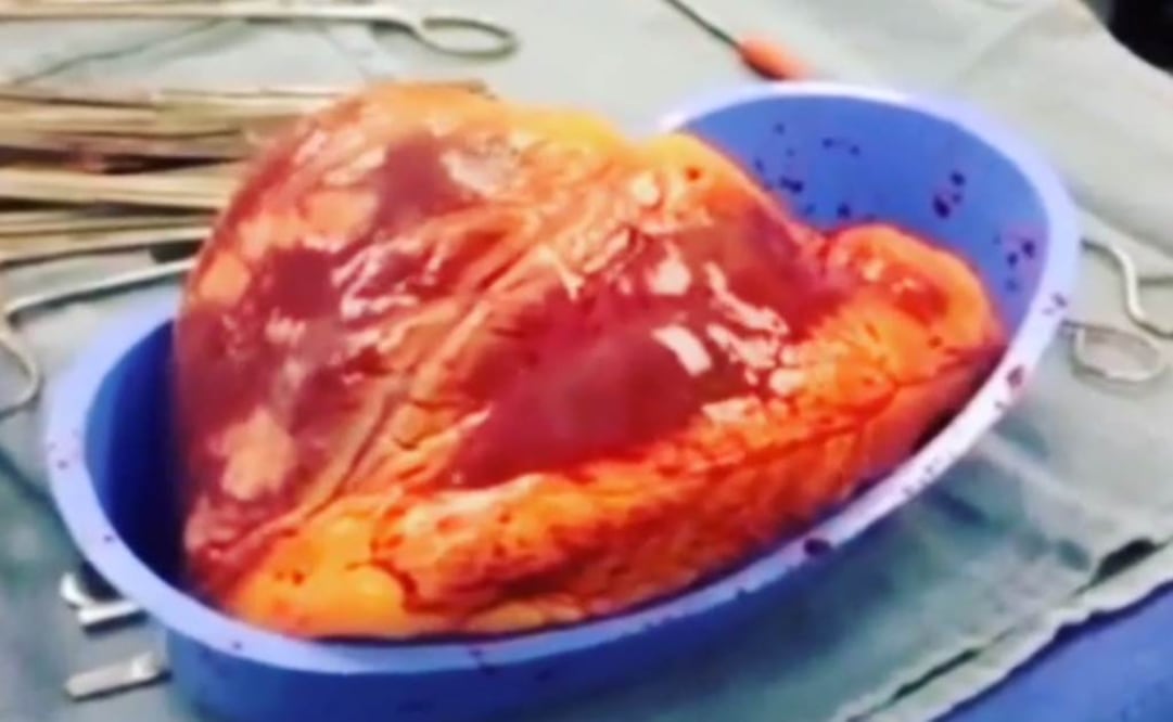 Órgano aumentó tres veces su tamaño debido al abuso de cocaína. Foto: Medspiration