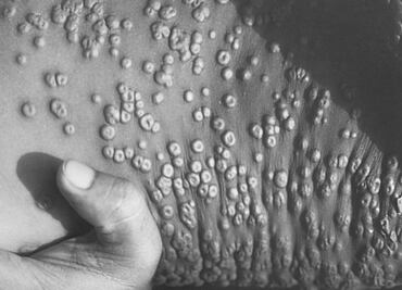 Viruela del mono: SSa lanza aviso epidemiológico por emergencia de salud internacional sobre brote de mpox