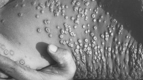 Viruela del mono: SSa lanza aviso epidemiológico por emergencia de salud internacional sobre brote de mpox