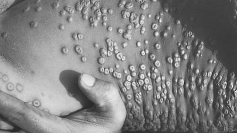 Viruela del mono: SSa lanza aviso epidemiológico por emergencia de salud internacional sobre brote de mpox