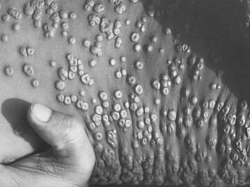 Viruela del mono: SSa lanza aviso epidemiológico por emergencia de salud internacional sobre brote de mpox
