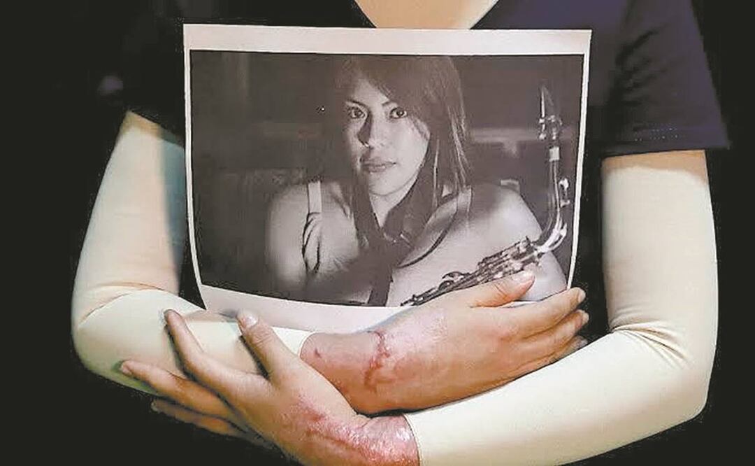 La joven María Elena Ríos Ortiz sufrió una agresión con ácido en septiembre del año pasado. Foto: ARCHIVO EL UNIVERSAL