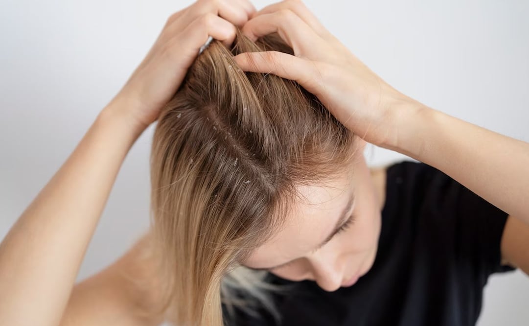 Descubre el motivo por el que te pica la cabeza. Foto: Freepik