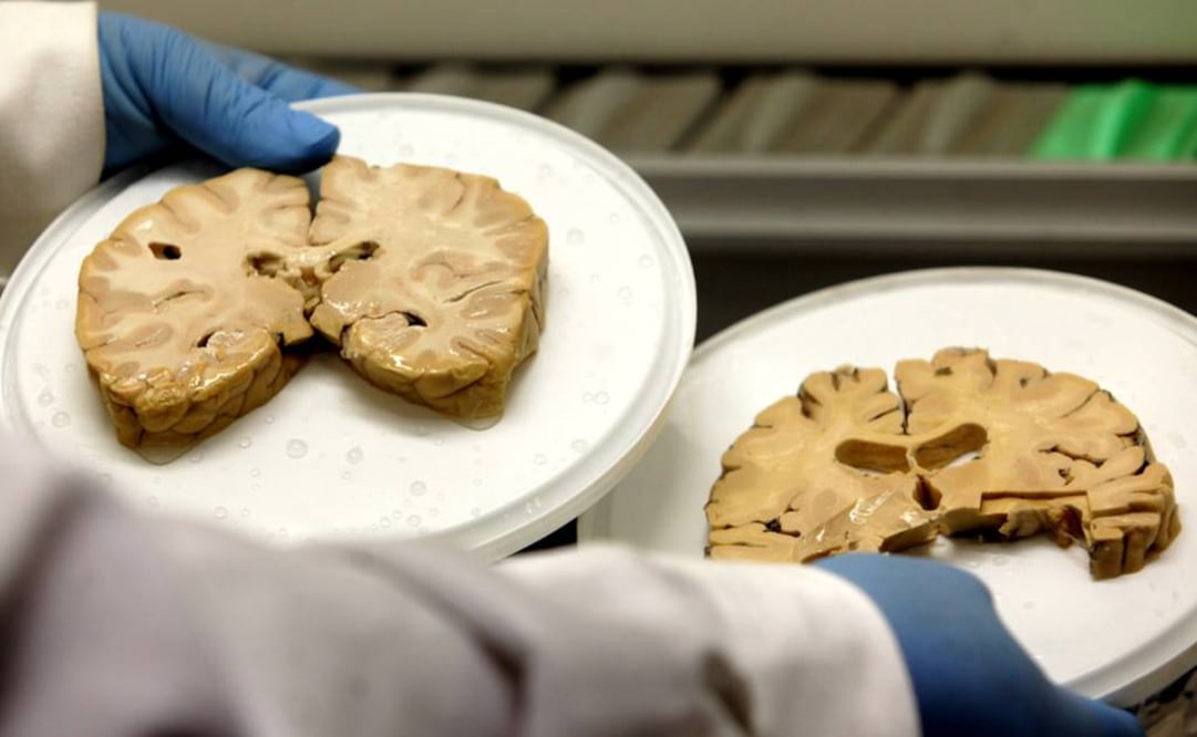 En distintas regiones del cerebro de fallecidos con alzheimer se observan hongos. Foto: Archivo