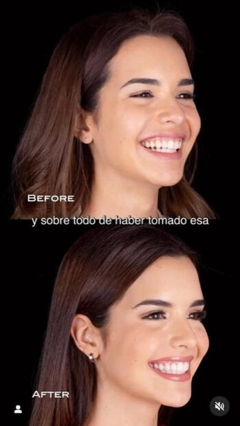 No podrás creer como lucía Amanda Dudamel, primera princesa de Miss Universo, antes de las cirugías