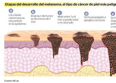Aumenta cáncer de piel en población más joven