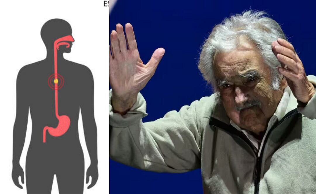 La próxima cirugía del expresidente José Mujica será un stent esofágico. (25/12/24) Fotos: iStock y Archivo