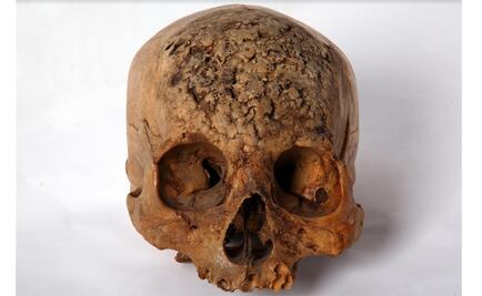 Exposición muestra infecciones en restos óseos de México