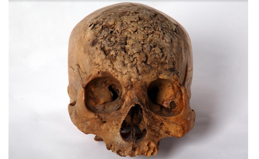 "La enfermedad de Venus" aborda las evidencias históricas de infección por treponemas. Foto: DAF INAH