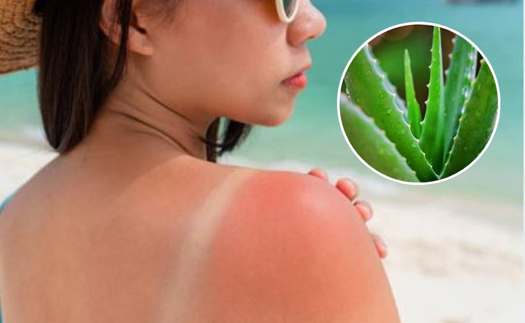 La sábila alivia las quemaduras en poco tiempo. Foto: Pixabay