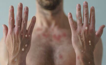 Reportan tercer caso de viruela del mono en Coahuila