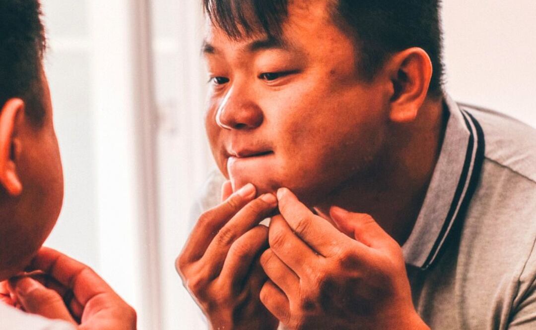 Aceite y acné. Fuente: Pixabay