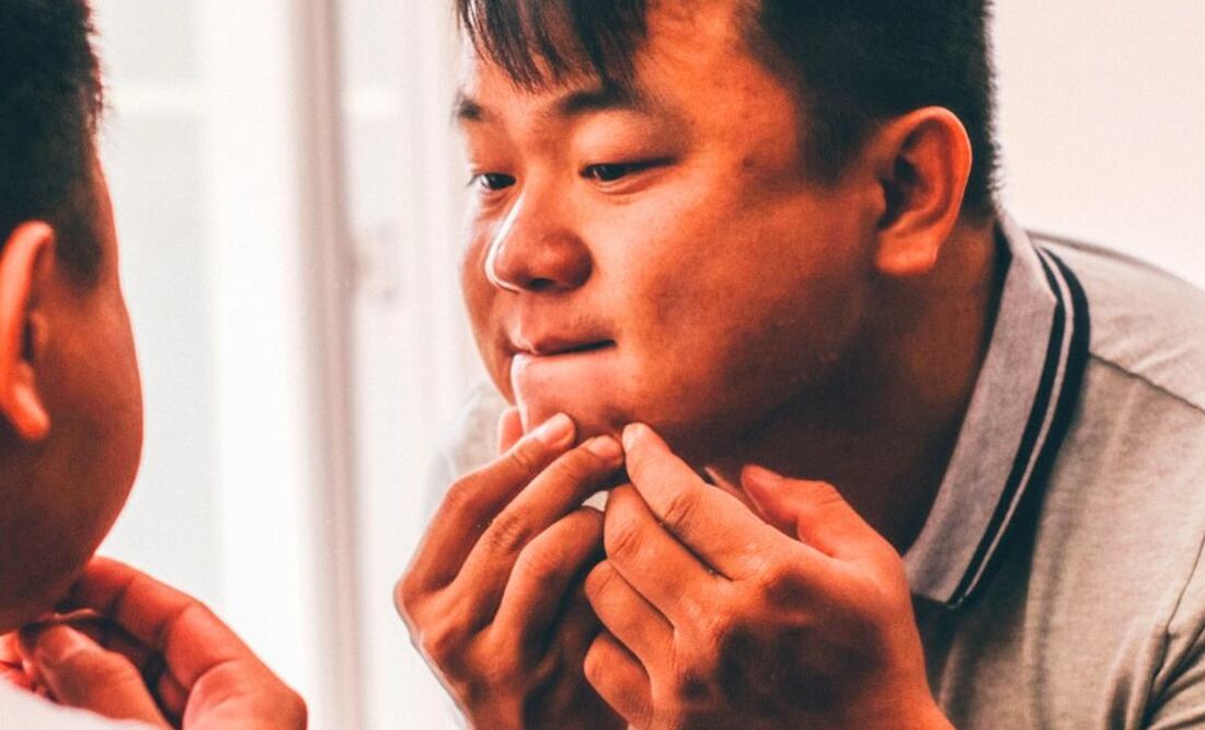 Aceite y acné. Fuente: Pixabay