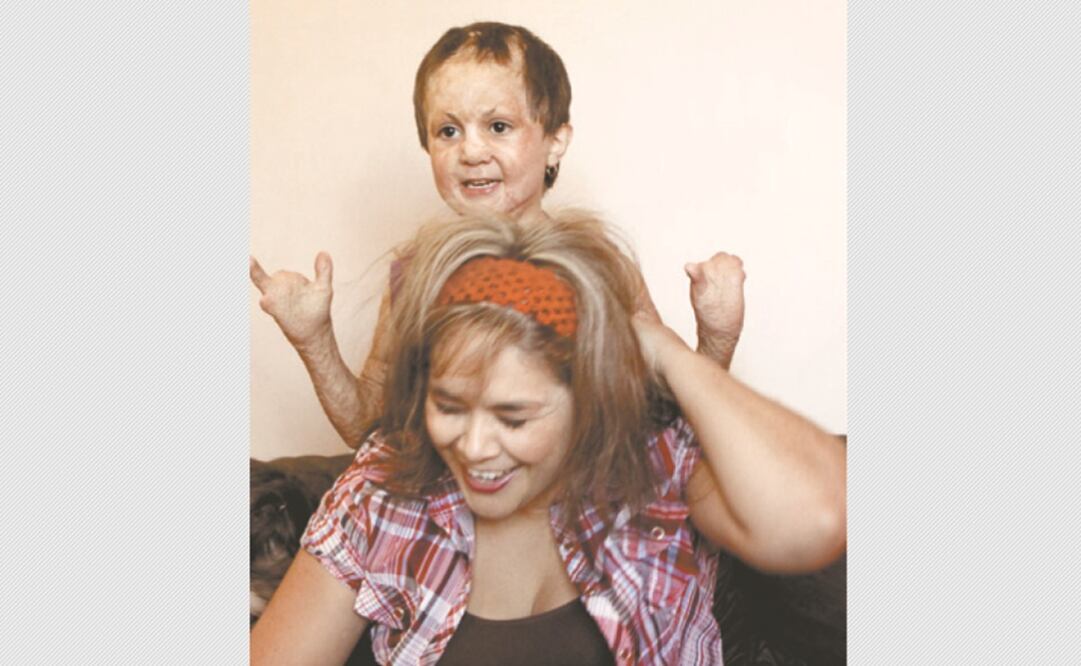 Alejandra Guadalupe, en junio de 2009 sufrió quemaduras de tercer grado en 80% de su cuerpo y la amputación de siete dedos de sus manitas.