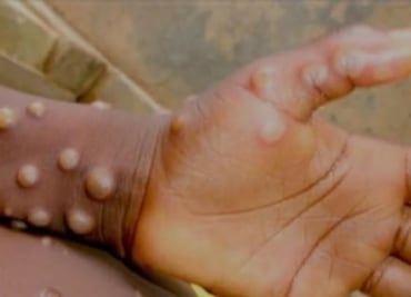OMS declara nuevamente el mpox, antes viruela del mono, como emergencia internacional de salud pública