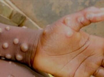 OMS declara nuevamente el mpox, antes viruela del mono, como emergencia internacional de salud pública