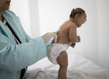 Detectan caso de microcefalia en Venezuela