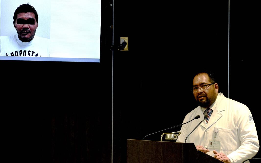 Carlos Eduardo Ordoñez Morales, coordinador de la Unidad Médico Quirúrgica del Hospital Juárez del Centro, explica el procedimiento realizado para extirpar, reconstruir y rehabilitar al paciente. Foto: Especial