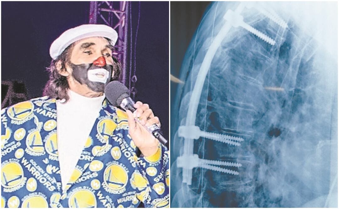 Así se ve la radiografía del payaso: le pusieron dos varillas y ocho tornillos en la columna. Será dado de alta el fin de semana. Fotos: Archivo El Universal y cortesía Ricardo González