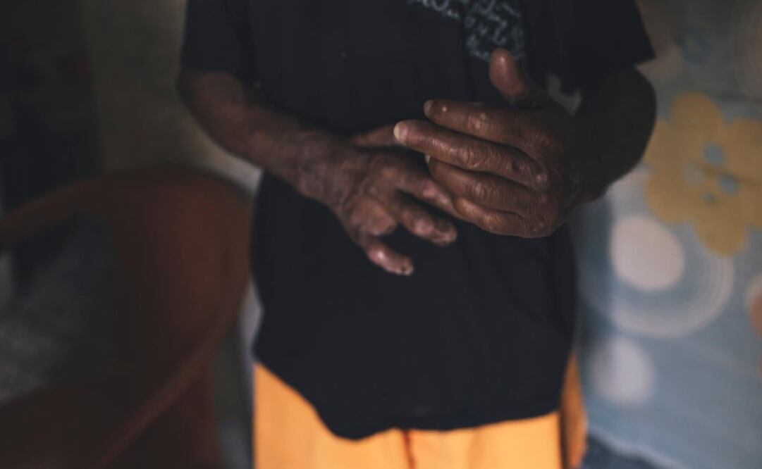 Gerhard Henrik Armauer Hansen descubrió la bacteria que causa la enfermedad en 1873 - Foto: Joshua E. Cogan