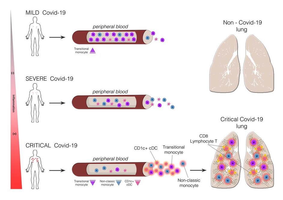 COVID-19 afecta a distintas células del sistema inmunitario según la gravedad