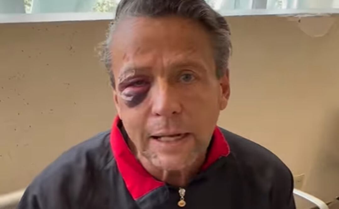El actor sufrió cuatro fracturas en el rostro y una lesión fuerte en el ojo derecho   Foto:Instagram