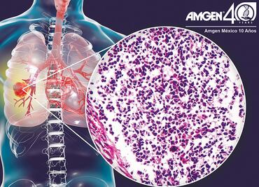 El cáncer de pulmón es prevenible en el 80% de los casos