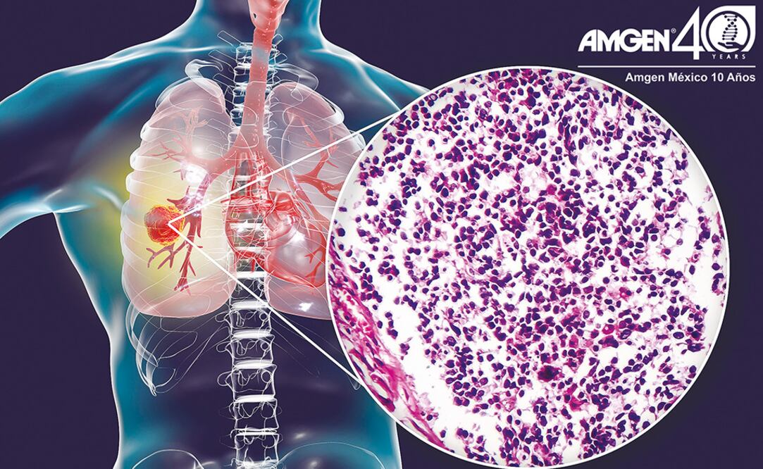 El cáncer de pulmón es prevenible en el 80% de los casos. Foto: Cortesía Amgen