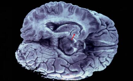 Desarrollan molécula que combate el cáncer