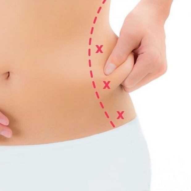 Cuánto cuesta la liposucción: conoce los métodos no invasivos