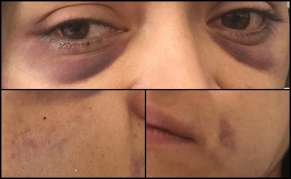 Periodista acusa golpiza de policías al denunciar intento de violación en Morelia