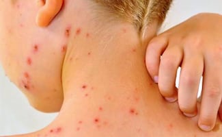 Sube a 31 fallecimientos por sarampión en México; van 9 mil 850 contagios