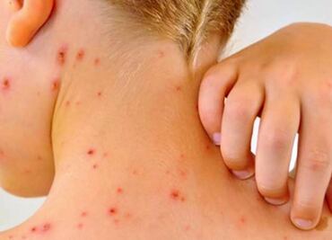 Conave emite aviso epidemiológico por sarampión; hay 21 casos confirmados en México