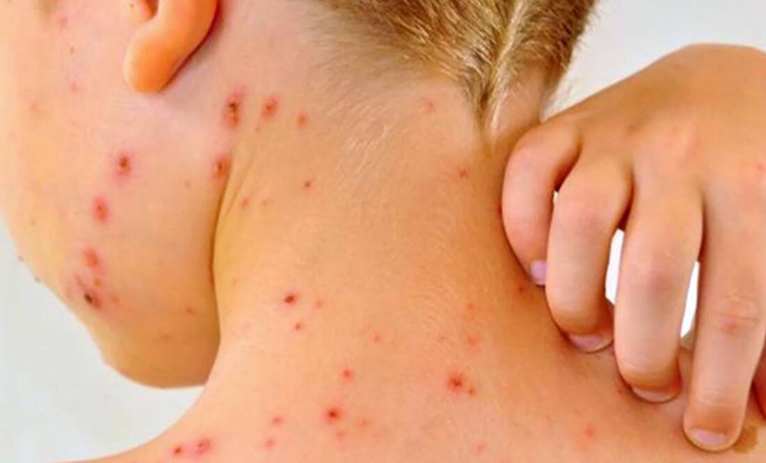 Muere segundo menor en EU por causas relacionadas al sarampión. Imagen ilustrativa. Foto: Especial