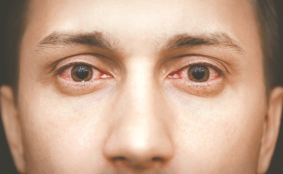 Es común que se confunda con otras patologías y resulte difícil identificarlo. Foto: ESPECIAL