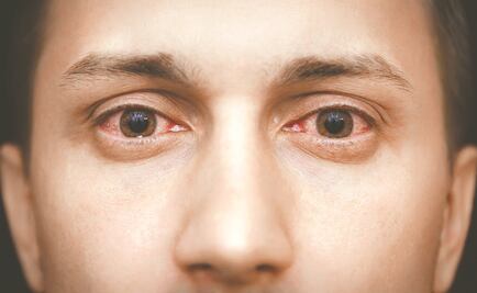 Síndrome de Sjögren: uno de los principales trastornos autoinmunes