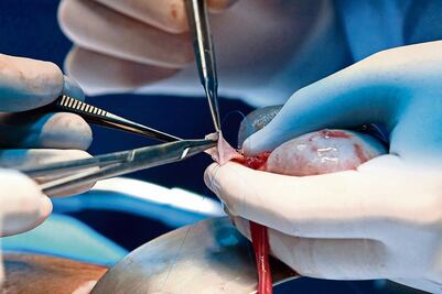 Muere un hombre en EU al que se le extirpó el órgano equivocado