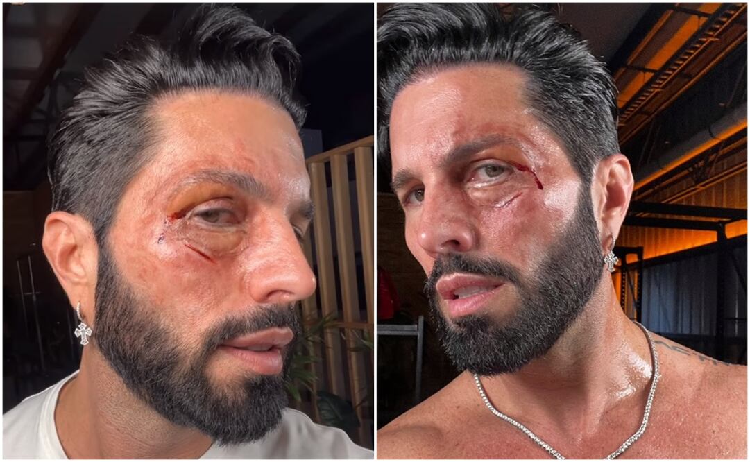 Poncho de Nigris da de qué hablar por aparecer con el rostro golpeado.