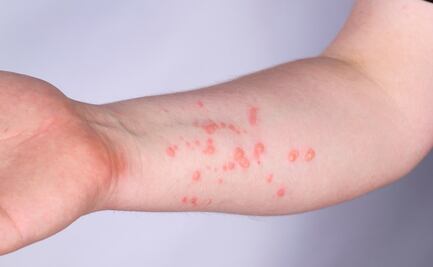 Congreso de CDMX pide a autoridades valorar compra de vacuna contra viruela del mono