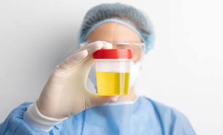 ¿Cómo es el color de la orina en las personas que sufren insuficiencia renal?