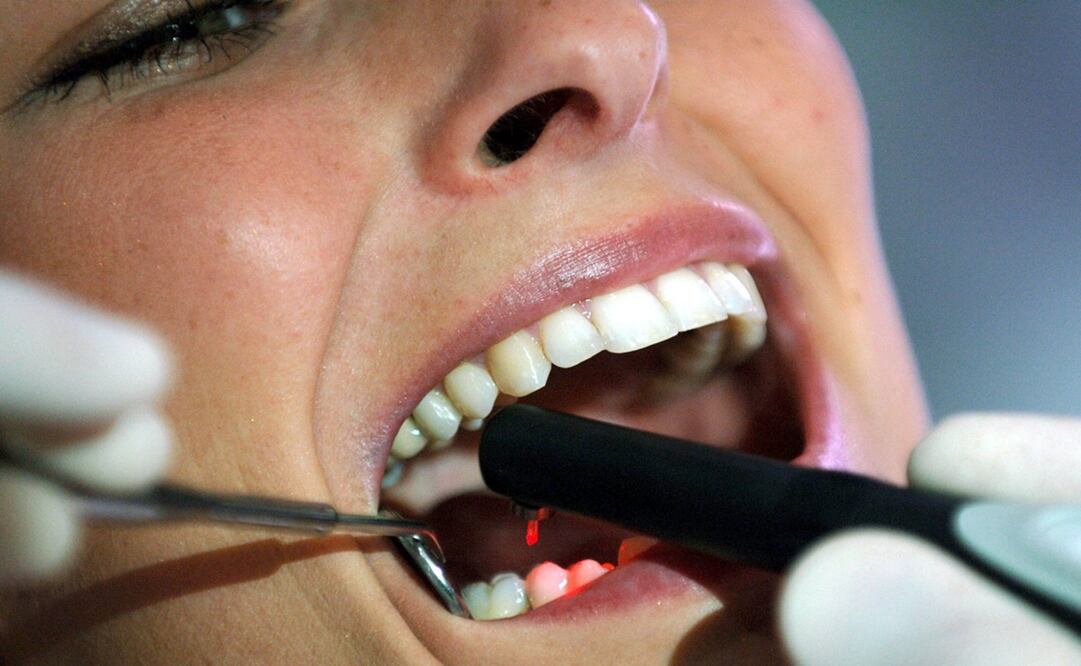 Un dentista muestra cómo gracias a la ayuda del rayo láser detecta las caries que se camuflan entre los dientes - Foto: Olivier Berg/EFE