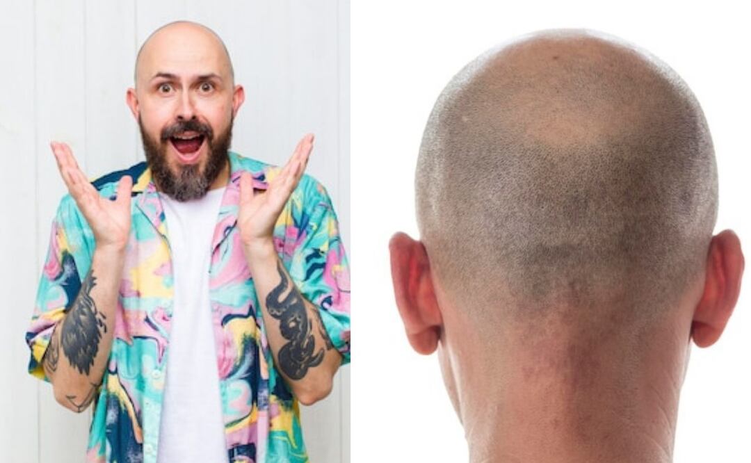 Conceptos básicos de cómo abordar la calvicie. Fuente: Freepik.