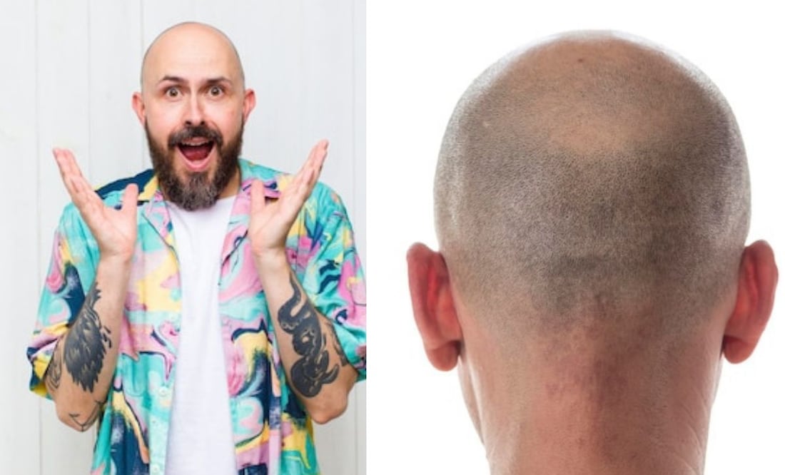 Conceptos básicos de cómo abordar la calvicie. Fuente: Freepik.