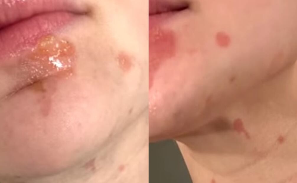 Joey King muestra sus quemaduras. Foto: Instagram oficial.