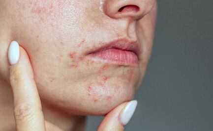 Dermatitis perioral: guía de autocuidados para pieles sensibles