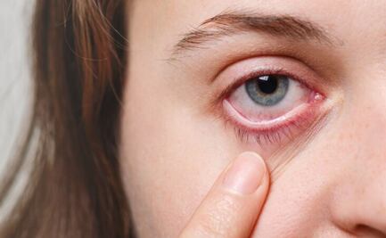 ¿Ojos hinchados por la mañana?; estos 6 consejos te salvarán el día